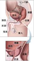 Prostatelead-Japanese.jpg